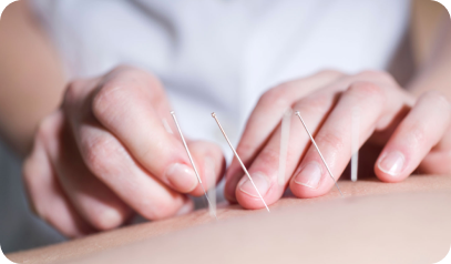 Acupuntura
